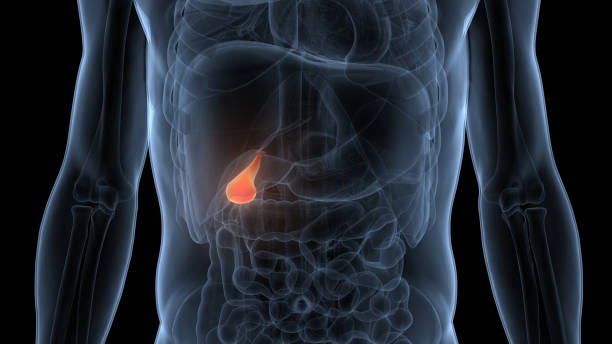 gall bladder stone